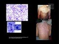 Advances in Infectious Disease Vaccines Advances in Infectious Disease Vaccines