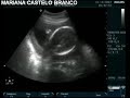 Ultrassom da Mariana com 24 semanas