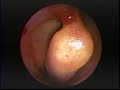 Anterior Bent Uncinate Process