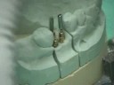 Large Maxillary Molar Restoration Part 2 Restoration