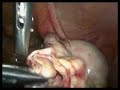 Excision of ovarian endometrioma by laparoscopy