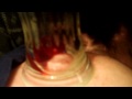 Cyst Exorcism.MOV