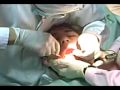 Dentistry Horrors: Wisdom tooth procedure (full)