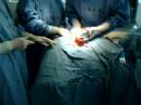 Laryngectomy