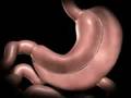 Laparoscopic Vertical Sleeve Gastrectomy by Marc Zare, MD