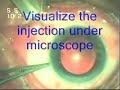 Intravitreal Injection Avastin In WET AMD Dr. Sudhalkar
