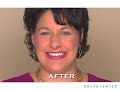 BriteSmile Veneers Teeth Whitening Experience