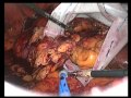 Renal Cell Cancer - Laparoscopic Partial Nephrectomy Renal Cell Cancer - Laparoscopic Partial Nephrectomy