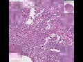 Metastatic breast carcinoma Metastatic breast carcinoma