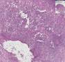 Histopathology Lymph node--Metastatic breast carcinoma