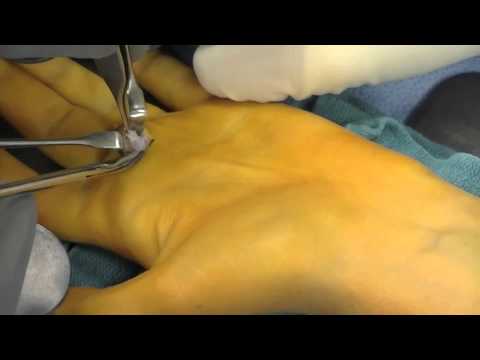 how to draw out a cyst