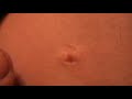 Zit on arm - Close up squeez