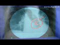 Doctors Diagnose Over Dire Distances : DigInfo Facial diagnosis