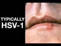 Who Has Herpes? (Sex Health Guru Trivia)