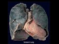stop smoking