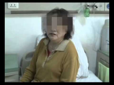 17. MND Patient Mrs Meng’s Recovery with Stem Cell Treatment （Before）