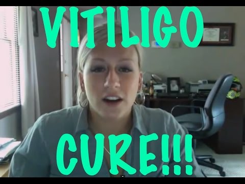 how to cure vitiligo