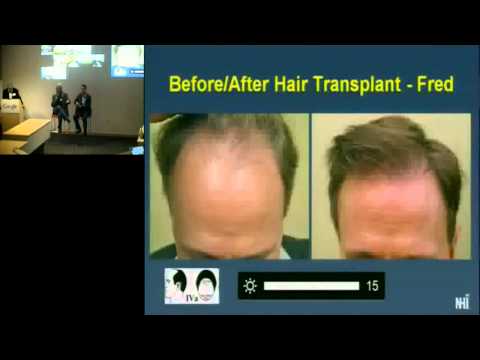 Health@Google Series: Hair Loss and Hair Restoration