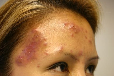 The Acne Practice  (severe case 5)