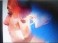 Implantes-De-Titanio
