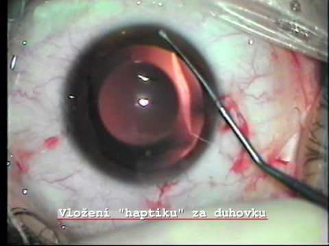 accommodating intraocular lens. Implantation of Visian ICL - intraocular phakic lens STAAR. Easy surgery, just do no touch the lens. Prague