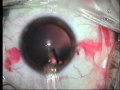 Implantation of Visian ICL - intraocular phakic lens STAAR