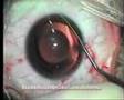 Implantation of Visian ICL - intraocular phakic lens STAAR