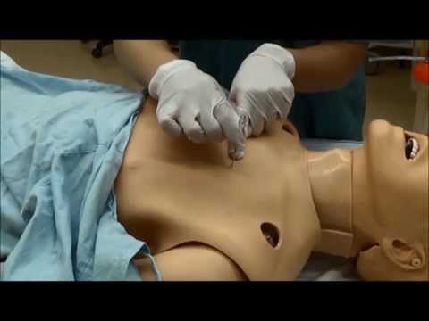 how to cure pneumothorax