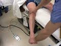 LCL rupture