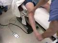 LCL rupture