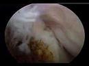 My Knee Surgery