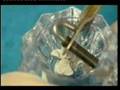 amalgam fillings  in your mouth are poisoning you part 1