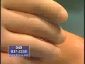 Bunion Surgery Expert Dr. Moy Segment 3 of 5