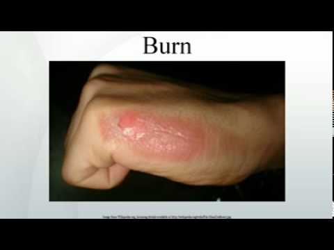 how to treat hf burn