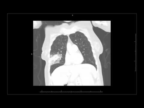 how to discover lung cancer