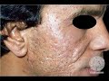 Acne Scars at Home