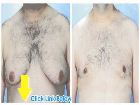 how to get rid of gyno lumps