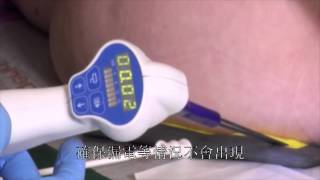 痔瘡水解技術