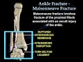 Ankle Fracture Maisonneuve Fracture - Everything You Need To Know - Dr. Nabil Ebraheim