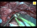 Neurosurgery Video Bifrontal Glioma
