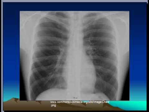 how to assess chest x ray