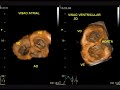 Amiloidose Echo 3D