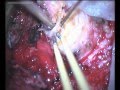 C1-C2 Schwannoma - Right extradural approach
