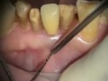 Implant Microsurgery: Atypical Infection and Repair