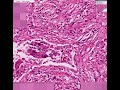 Histopathology Lung--Metastatic leiomyosarcoma