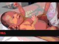 Fetal Alcohol Syndrome