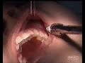 extraction dentaire ( tooth extraction)