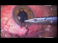 ARTISAN OCCLUDER FOR THE TREATMENT OF INTRACTABLE DIPLOPIA ARTISAN OCCLUDER FOR THE TREATMENT OF INTRACTABLE DIPLOPIA