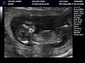 Taylor Twins - Baby B sucking thumb! Taylor Twins - Baby B sucking thumb!