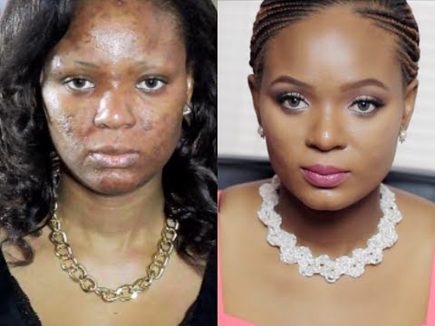My Skin Care Miracle! How I Got Rid of Acne. Acne.org \